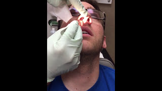 Deviated Septum Splint Removal [upl. by Pik]