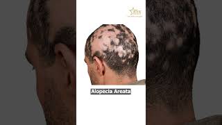 What is Alopecia Areata  How it Affects Body  DrNeelima Potluri  NVK Aesthetics [upl. by Winstonn]