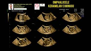 Omphalocele 13 minggu [upl. by Eihtak22]