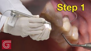 HOW TO Decontaminate Zirconia Crown AFTER Intraoral TryIn [upl. by Reisman]