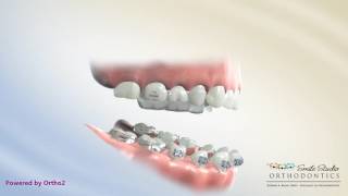 Anterior Crossbite RPE Correction  Orthodontic Treatment [upl. by Elbart657]