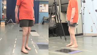 Functional Ambulation Patient Without Orthoses [upl. by Cypro]