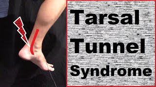 Understanding amp Treating Tarsal Tunnel Syndrome [upl. by Kristos]