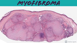 Myofibroma amp Myofibromatosis 101 [upl. by Shakespeare]