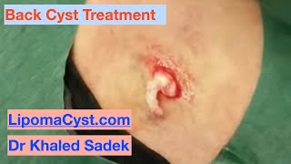 Cyst Removal Dr Khaled Sadek LipomaCystcom [upl. by Yroffej]