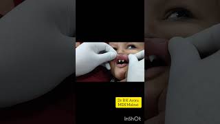 Ectodermal Dysplasia Syndrome dentistdentistnearby [upl. by Deibel]