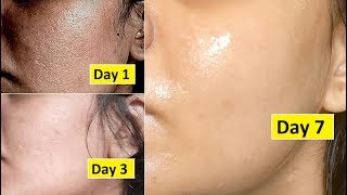 Skin Repair  Close Large OPEN PORES in 1 week Remove Dark Spots Anti Aging [upl. by Hibbert]