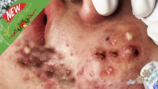 Blackheads amp Acne Treatment Hottest Videos 128 [upl. by Crudden366]