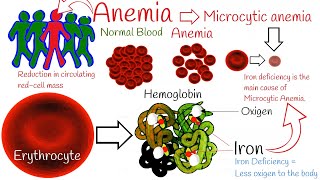 Iron deficiency anemia  Most Common anemia Microcytic anemia symptoms and treatment [upl. by Bickart]