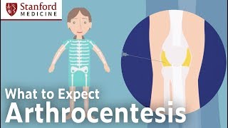 Arthrocentesis – What to Expect [upl. by Namas]