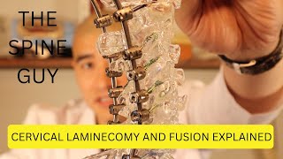 Cervical Laminectomy and Fusion Explained [upl. by Charil660]