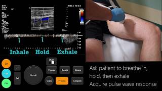 Ultrasound Tutorial DVT  Lower Limb Veins  Radiology Nation [upl. by Eniamret200]