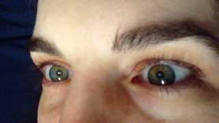 What Sectoral Heterochromia Looks Like In Eyes [upl. by Hong]