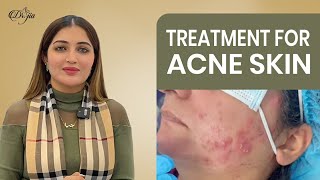 Treatment For Acne Skin  Treatment For Active Acne  Best Dermatologist and Skin Care Specialist [upl. by Ballard943]