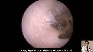 Top Biggest Ear Wax Removal 80  Ear wax Extraction  Dr S Thouk Earwax Specialist [upl. by Anitnoc]