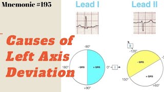 What are the Causes of Left Axis Deviation ECG  A simple Mnemonic to memorize all causes [upl. by Tennes613]