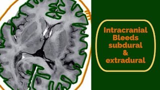 Intracranial bleeds Subdural and Extradural haematoma [upl. by Ecarret985]