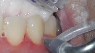 Airflow Teeth Polishing [upl. by Inaliel]