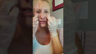 Getting better at Meso Mesotherapy with Miracle L  PCL DIY Facial [upl. by Auqemahs205]