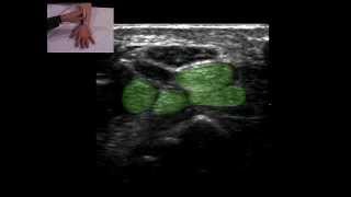 Musculoskeletal Ultrasound Wrist 1 volar transverse scan [upl. by Farnsworth522]