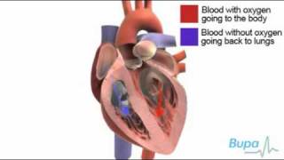 Heart valve replacement surgery [upl. by Robena]