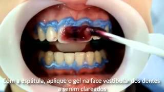 Whiteness HP Maxx  FGM l Dental Speed [upl. by Hirz353]