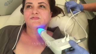 BTL Exilis Ultra  Neck Lift Skin Tightening  Cellulite Reduction  Beverly Hills [upl. by Germayne903]