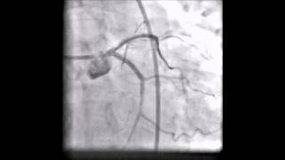 Left main coronary angioplasty due to dissection [upl. by Calandra961]