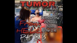 Tumor from Hell Pt 35 After 12hr tumor removal surgery Graphic images removed [upl. by Fernyak]