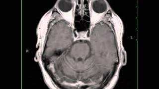 Paraneoplastic Cerebellar Atrophy [upl. by Lydia]