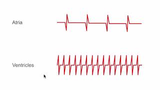 Detecting arrhythmias with ICDs [upl. by Atteirneh]