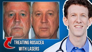 How Can Lasers Help Rosacea [upl. by Werdna375]