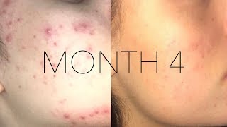 Accutane Month 4 PURGING SCARRING [upl. by Naleag496]