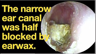 The narrow ear canal was half blocked by earwaxear wax removal  ear cleaning  ASMR relax [upl. by Nesnar609]