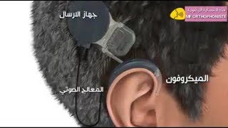 الجهاز القوقعي و طريقة عمله داخل الأذن  implant cochléaire [upl. by Nahguav]