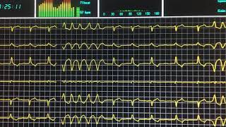 MIOCARDIOPATIA DILATADA Y TAQUICARDIA VENTRICULAR EN MONITOR  caso clinico [upl. by Ettennaj168]