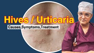 HivesUrticaria Explained Causes Symptoms and Treatments  Skin Rash  Allergy Dr naren pandey [upl. by Richela763]