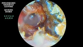 采耳哥External auditory canal cholesteatoma and fungal steatoma ｜585 [upl. by Ahsart]