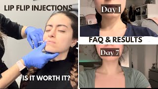 Lip flip botox injection  day by day comparison  FAQ amp results  everything you need to know [upl. by Lengel]