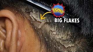 Psoriasis Scalp Scratching Big Flakes Dandruff Removal Satisfying 322 [upl. by Ilegna349]