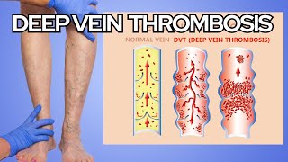 Understanding Deep Vein Thrombosis DVT in Seniors Risks Complications and Prevention [upl. by Ollayos]