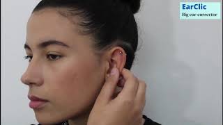 Protruding ear corrector EARCLIC [upl. by Austen458]