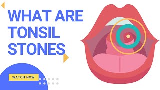 What are Tonsil Stones Tonsillolith How to treat them [upl. by Engelbert]