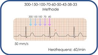 EKGBefundung Herzfrequenz in Sekunden bestimmen 300150100Methode [upl. by Milburr]