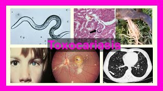 toxocariasis [upl. by Asilla516]