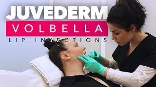 Juvederm Volbella Lip Injections  Juvederm Volbella Los Angeles CA [upl. by Naoh]