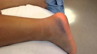 Quick test for Achilles tendon rupture [upl. by Jareen]