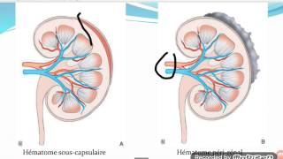 🔵Contusion rénaleclassification AAST [upl. by Lirret]