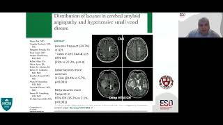 Lacunar Ischaemic Stroke  Clinical Perspectives [upl. by Akimak]