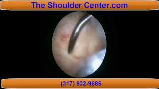 Calcium Deposits Shoulder Surgery and How to Treat Calcific Tendonitis [upl. by Lexa]